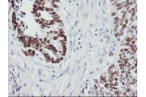 Immunohistochemistry (IHC) image for anti-Tumor Protein P53 (TP53) antibody (ABIN1499972) (p53 抗体)
