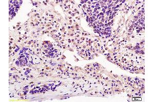 Formalin-fixed and paraffin embedded human lung carcinoma labeled with Anti-ICOS/CD278 Polyclonal Antibody, Unconjugated (ABIN742380) at 1:200 followed by conjugation to the secondary antibody and DAB staining (ICOS 抗体  (AA 51-150))