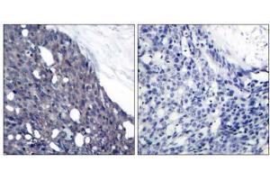 Immunohistochemical analysis of paraffin-embedded human breast carcinoma tissue using IκB-α (Ab-42) antibody (E021176). (NFKBIA 抗体)