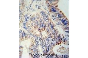 B3GNT6 Antibody (Center) (ABIN653842 and ABIN2843106) immunohistochemistry analysis in formalin fixed and paraffin embedded human colon carcinoma followed by peroxidase conjugation of the secondary antibody and DAB staining. (B3GNT6 抗体  (AA 146-173))