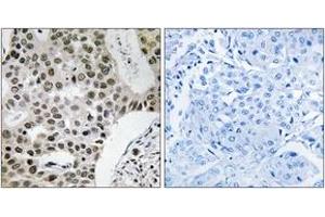 Immunohistochemistry analysis of paraffin-embedded human breast carcinoma tissue, using ZMYM4 Antibody. (ZMYM4 抗体  (AA 801-850))