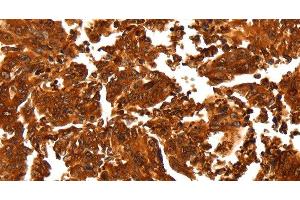 Immunohistochemistry of paraffin-embedded Human gastic cancer using ALDOA Polyclonal Antibody at dilution of 1:30 (ALDOA 抗体)