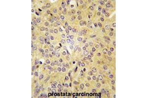 Formalin-fixed and paraffin-embedded human prostate carcinomareacted with LARS polyclonal antibody , which was peroxidase-conjugated to the secondary antibody, followed by AEC staining. (LARS 抗体  (C-Term))