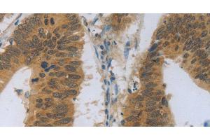 Immunohistochemistry of paraffin-embedded Human colon cancer using TNFRSF11B Polyclonal Antibody at dilution of 1:30 (Osteoprotegerin 抗体)