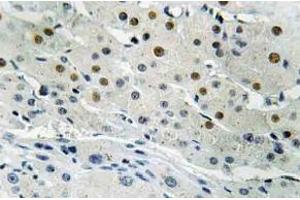 Immunohistochemistry (IHC) analyzes of Dlx-4 antibody in paraffin-embedded human liver carcinoma tissue. (DLX4 抗体)