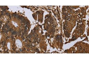 Immunohistochemistry of paraffin-embedded Human colon cancer tissue using MYBBP1A Polyclonal Antibody at dilution 1:40 (MYBBP1A 抗体)
