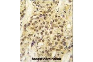 Formalin-fixed and paraffin-embedded human breast carcinoma tissue reacted with HMOF/MYST1 antibody (C-term) (ABIN387971 and ABIN2844732) , which was peroxidase-conjugated to the secondary antibody, followed by DAB staining. (MYST1 抗体  (C-Term))
