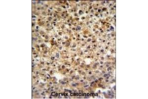 KI Antibody (C-term) (ABIN651358 and ABIN2840200) IHC analysis in formalin fixed and paraffin embedded human cervix carcinoma followed by peroxidase conjugation of the secondary antibody and DAB staining. (CCDC180 抗体  (C-Term))