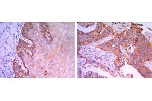 Immunohistochemical analysis of paraffin-embedded esophagus tissues (left) and human lung cancer (right) using Rab25 mouse mAb with DAB staining. (RAB25 抗体)