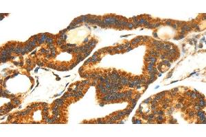 Immunohistochemistry of paraffin-embedded Human thyroid cancer tissue using SMYD4 Polyclonal Antibody at dilution 1:40 (SMYD4 抗体)