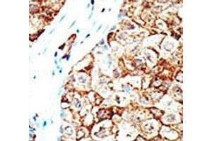 IHC analysis of FFPE human breast carcinoma tissue stained with the Ubiquilin1 antibody (Ubiquilin 1 抗体  (AA 296-326))