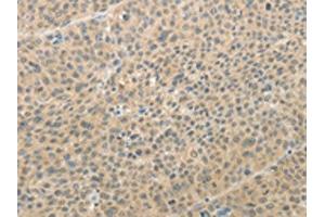 The image on the left is immunohistochemistry of paraffin-embedded Human liver cancer tissue using ABIN7189710(AFF2 Antibody) at dilution 1/25, on the right is treated with synthetic peptide. (AFF2 抗体)