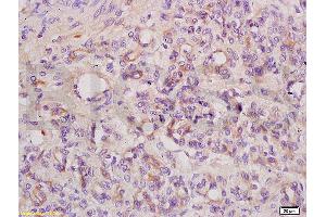 Formalin-fixed and paraffin embedded mouse tumor tissue labeled with Anti ANGPT3 ANG3 ANGPT4 ANG4 Polyclonal Antibody, unconjugated (ABIN737466) at 1:200 followed by incubation with conjugated secondary antibody and DAB staining. (Angiopoietin 4 抗体  (AA 410-503))