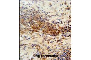 DNAJC11 antibody immunohistochemistry analysis in formalin fixed and paraffin embedded human lung carcinoma followed by peroxidase conjugation of the secondary antibody and DAB staining. (DNAJC11 抗体  (N-Term))