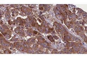 ABIN6277630 at 1/100 staining Human liver cancer tissue by IHC-P. (GNAS 抗体  (C-Term))