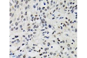 Immunohistochemistry of paraffin-embedded Human lung cancer using SMARCAD1 Polyclonal Antibody at dilution of 1:100 (40x lens). (SMARCAD1 抗体)