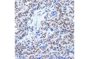 Immunohistochemistry of paraffin-embedded human thyroid cancer using RING1A Rabbit mAb (ABIN7270051) at dilution of 1:100 (40x lens). (RING1 抗体)