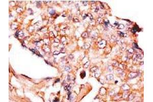 Formalin-fixed and paraffin-embedded human breast carcinoma reacted with anti-NP1 (Nptx1) Antibody (Center), which was peroxidase-conjugated to the secondary antibody, followed by DAB staining. (NPX1 抗体  (Middle Region))
