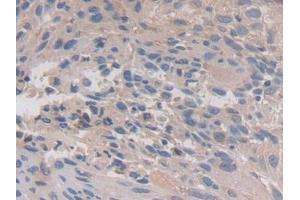 DAB staining on IHC-P; Samples: Human Lung cancer Tissue (Calpain 3 抗体  (AA 602-821))