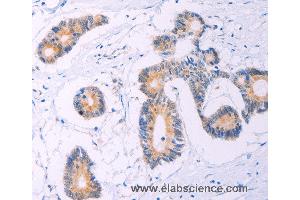 Immunohistochemistry of Human thyroid cancer using ADCY5 Polyclonal Antibody at dilution of 1:30 (ADCY5 抗体)