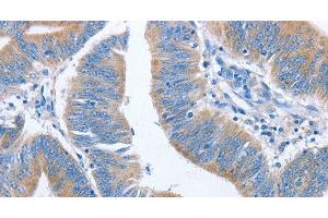 Immunohistochemistry of paraffin-embedded Human colon cancer using NCAPD2 Polyclonal Antibody at dilution of 1:40 (NCAPD2 抗体)