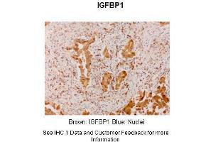 Sample Type :  Human lung adenocarcinoma  Primary Antibody Dilution :  1:300  Secondary Antibody :  Anti-rabbit-linker, Fbex-HRP  Secondary Antibody Dilution :  NOT FOUND  Color/Signal Descriptions :  Brown: IGFBP1 Blue: Nuclei  Gene Name :  IGF2BP1  Submitted by :  Haodong Xu. (IGF2BP1 抗体  (N-Term))