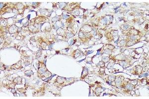 Immunohistochemistry of paraffin-embedded Human mammary cancer using SLC7A2 Polyclonal Antibody at dilution of 1:100 (40x lens). (SLC7A2 抗体)