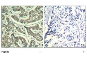Immunohistochemical analysis of paraffin-embedded human breast carcinoma tissue using ATR polyclonal antibody . (ATR 抗体  (Ser428))