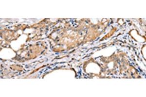 Immunohistochemistry of paraffin-embedded Human thyroid cancer tissue using LRRC19 Polyclonal Antibody at dilution of 1:30(x200) (LRRC19 抗体)