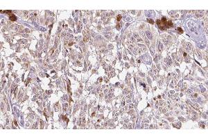 ABIN6275310 at 1/100 staining Human Melanoma tissue by IHC-P. (VGF 抗体  (Internal Region))