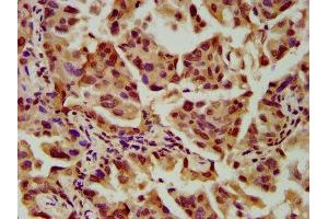 IHC image of ABIN7169791 diluted at 1:600 and staining in paraffin-embedded human lung cancer performed on a Leica BondTM system. (SLC2A4RG 抗体  (AA 1-100))
