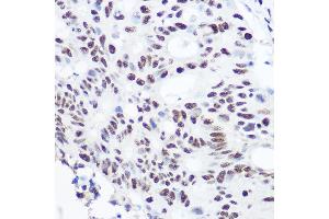 Immunohistochemistry of paraffin-embedded human colon carcinoma using S Rabbit pAb (ABIN6128698, ABIN6147392, ABIN6147393 and ABIN6215703) at dilution of 1:100 (40x lens).