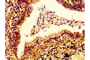 IHC image of ABIN7151695 diluted at 1:100 and staining in paraffin-embedded human lung cancer performed on a Leica BondTM system. (ERGIC2 抗体  (AA 55-310))