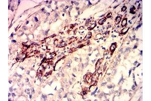 Immunohistochemical analysis of paraffin-embedded bladder cancer tissues using CALD1 mouse mAb with DAB staining. (Caldesmon 抗体  (AA 26-207))