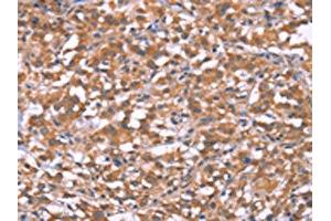 The image on the left is immunohistochemistry of paraffin-embedded Human thyroid cancer tissue using ABIN7190999(HRASLS2 Antibody) at dilution 1/20, on the right is treated with synthetic peptide. (HRASLS2 抗体)