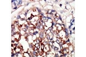 IHC analysis of FFPE human hepatocarcinoma tissue stained with the DYRKB antibody (DYRK1B 抗体  (AA 561-589))