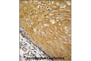 NUDT22 Antibody (C-term) (ABIN655227 and ABIN2844833) immunohistochemistry analysis in formalin fixed and paraffin embedded human esophageal carcinoma followed by peroxidase conjugation of the secondary antibody and DAB staining. (NUDT22 抗体  (C-Term))