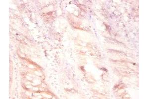 Immunohistochemistry of paraffin-embedded human colon cancer using ABIN7175129 at dilution of 1:100 (PLAU 抗体  (AA 21-173))