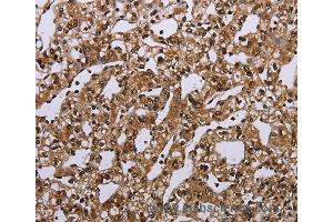 Immunohistochemistry of Human esophagus cancer using MEIS1 Polyclonal Antibody at dilution of 1:40 (MEIS1 抗体)
