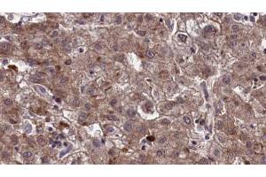 ABIN6273965 at 1/100 staining Human liver cancer tissue by IHC-P. (OR10Q1 抗体  (C-Term))