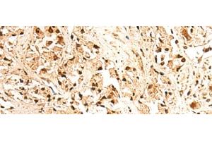 Immunohistochemistry of paraffin-embedded Human prost ate cancer tissue using JPT2 Polyclonal Antibody at dilution of 1:65(x200) (JPT2 抗体)