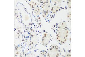 Immunohistochemistry of paraffin-embedded human gastric cancer using MECP2 antibody. (MECP2 抗体)