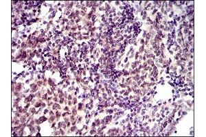 Immunohistochemical analysis of paraffin-embedded breast cancer tissues using ID2 mouse mAb with DAB staining.