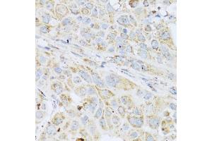 Immunohistochemistry of paraffin-embedded human esophageal cancer using LYZ antibody (ABIN5975352) at dilution of 1/100 (40x lens). (LYZ 抗体)