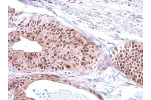 IHC-P Image Immunohistochemical analysis of paraffin-embedded human gastric cancer, using RFC3, antibody at 1:500 dilution. (RFC3 抗体)
