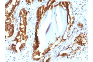 Formalin-fixed, paraffin-embedded human Prostate Carcinoma stained with PSAP Mouse Recombinant Monoclonal Antibody (rACPP/1338). (Recombinant ACPP 抗体)