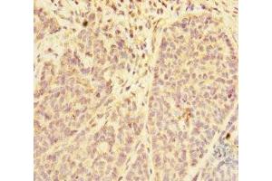 Immunohistochemistry of paraffin-embedded human ovarian cancer using ABIN7168416 at dilution of 1:100 (PDE6A 抗体  (AA 656-860))