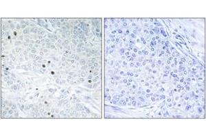 Immunohistochemistry analysis of paraffin-embedded human breast carcinoma tissue, using TP53INP2 Antibody. (TP53INP2 抗体  (AA 1-50))