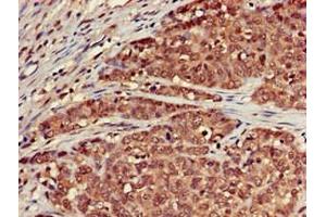 Immunohistochemistry of paraffin-embedded human ovarian cancer using ABIN7168699 at dilution of 1:100 (SCTR 抗体  (AA 51-135))