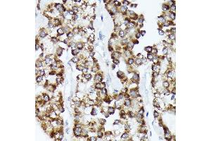 Immunohistochemistry of paraffin-embedded human liver cancer using CDC Rabbit mAb (ABIN7266261) at dilution of 1:100 (40x lens). (CDCA3 抗体)